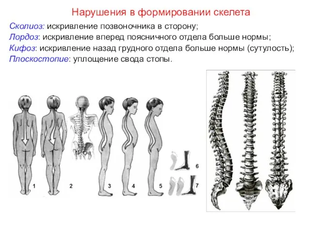 Сколиоз: искривление позвоночника в сторону; Лордоз: искривление вперед поясничного отдела больше