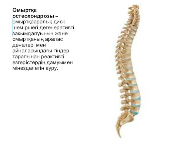 Омыртқа остеохондрозы – омыртқааралық диск шеміршегі дегенеративті зақымдалуының жəне омыртқаның аралас