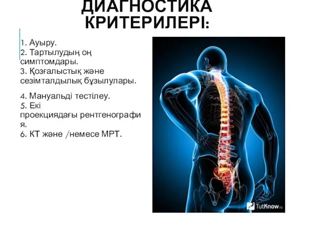 ДИАГНОСТИКА КРИТЕРИЛЕРІ: 1. Ауыру. 2. Тартылудың оң симптомдары. 3. Қозғалыстық жəне