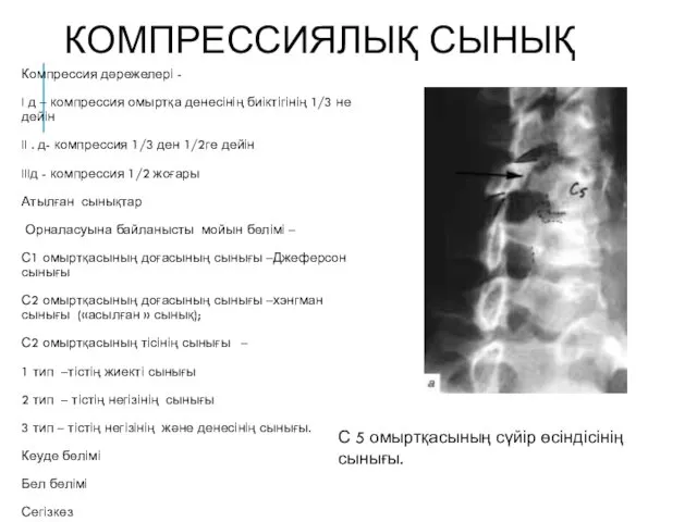 КОМПРЕССИЯЛЫҚ СЫНЫҚ Компрессия дәрежелері - I д – компрессия омыртқа денесінің