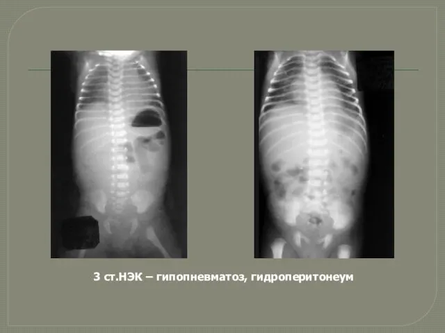 3 ст.НЭК – гипопневматоз, гидроперитонеум