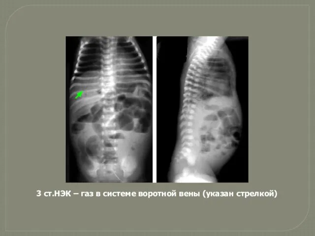 3 ст.НЭК – газ в системе воротной вены (указан стрелкой)