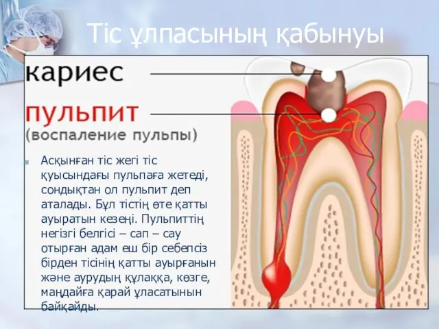 Тіс ұлпасының қабынуы Асқынған тіс жегі тіс қуысындағы пульпаға жетеді, сондықтан