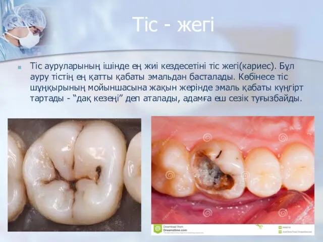 Тіс - жегі Тіс ауруларының ішінде ең жиі кездесетіні тіс жегі(кариес).