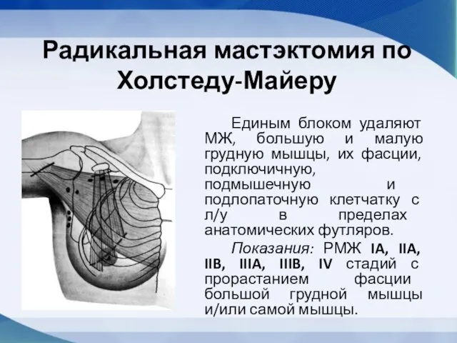 Радикальная мастэктомия по Холстеду-Майеру Единым блоком удаляют МЖ, большую и малую