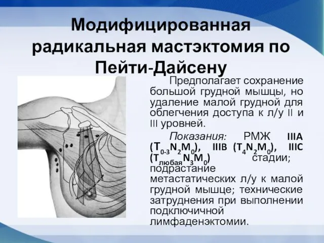 Модифицированная радикальная мастэктомия по Пейти-Дайсену Предполагает сохранение большой грудной мышцы, но