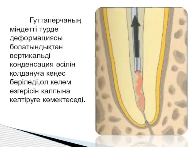 Гуттаперчаның міндетті турде деформациясы болатындықтан вертикальді конденсация әсілін қолдануға кеңес беріледі,ол көлем өзгерісін қалпына келтіруге көмектеседі.