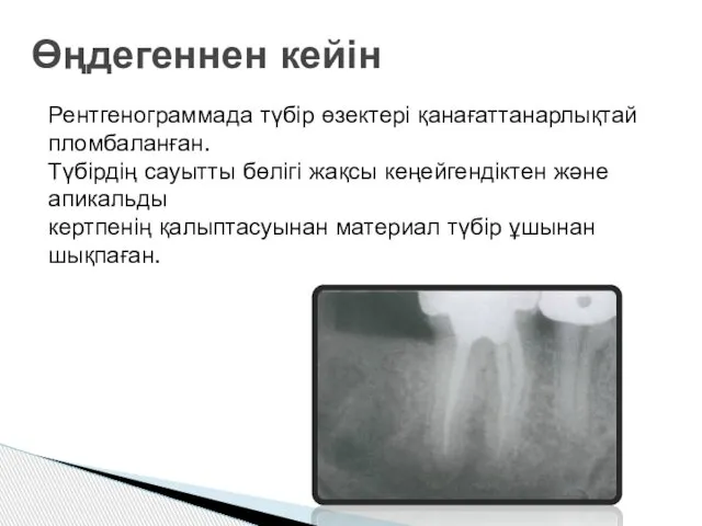 Өңдегеннен кейін Рентгенограммада түбір өзектері қанағаттанарлықтай пломбаланған. Түбірдің сауытты бөлігі жақсы