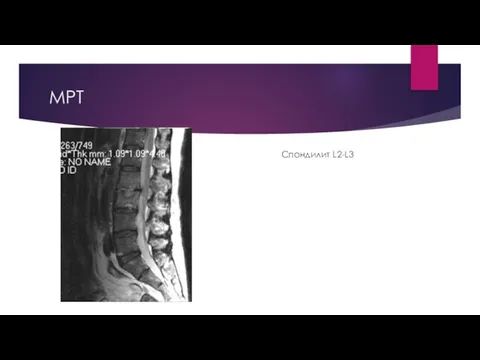МРТ Спондилит L2-L3