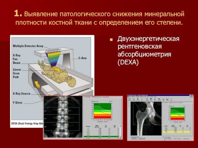 1. Выявление патологического снижения минеральной плотности костной ткани с определением его степени. Двухэнергетическая рентгеновская абсорбциометрия (DEXA)