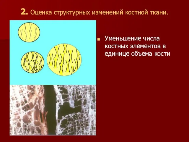 Уменьшение числа костных элементов в единице объема кости 2. Оценка структурных изменений костной ткани.