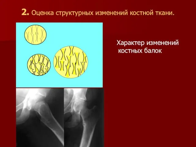 Характер изменений костных балок 2. Оценка структурных изменений костной ткани.