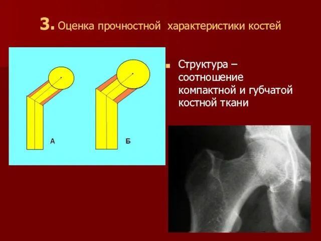 3. Оценка прочностной характеристики костей Структура – соотношение компактной и губчатой костной ткани