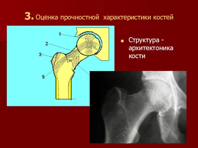 3. Оценка прочностной характеристики костей Структура - архитектоника кости