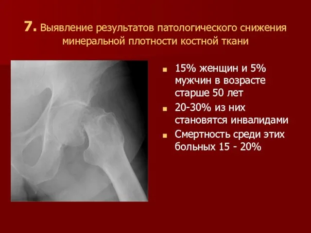 7. Выявление результатов патологического снижения минеральной плотности костной ткани 15% женщин