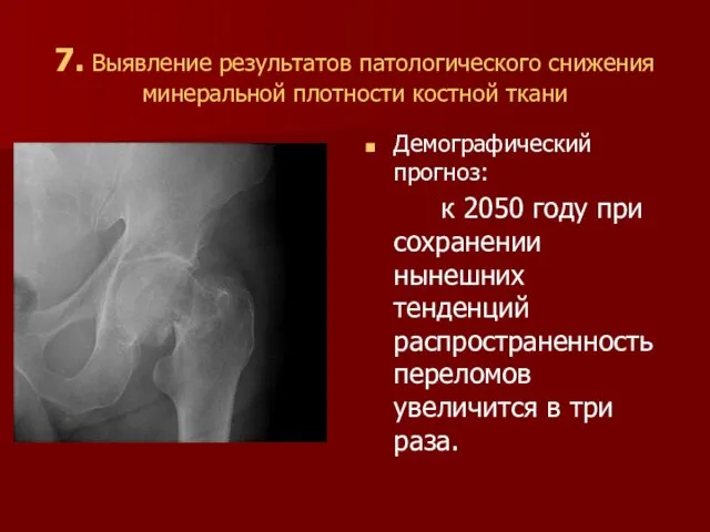 7. Выявление результатов патологического снижения минеральной плотности костной ткани Демографический прогноз: