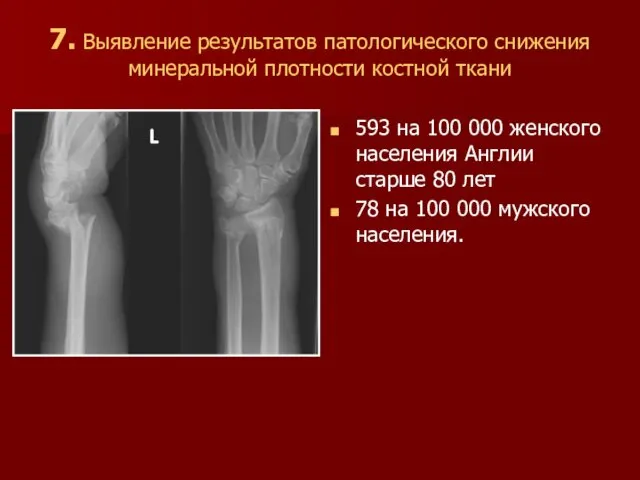 7. Выявление результатов патологического снижения минеральной плотности костной ткани 593 на