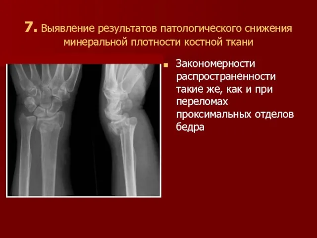 7. Выявление результатов патологического снижения минеральной плотности костной ткани Закономерности распространенности