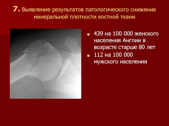 7. Выявление результатов патологического снижения минеральной плотности костной ткани 439 на