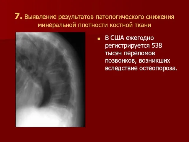 7. Выявление результатов патологического снижения минеральной плотности костной ткани В США