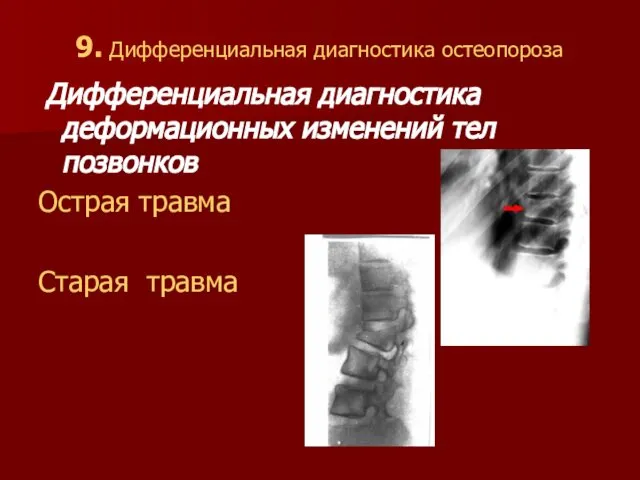 9. Дифференциальная диагностика остеопороза Дифференциальная диагностика деформационных изменений тел позвонков Острая травма Старая травма