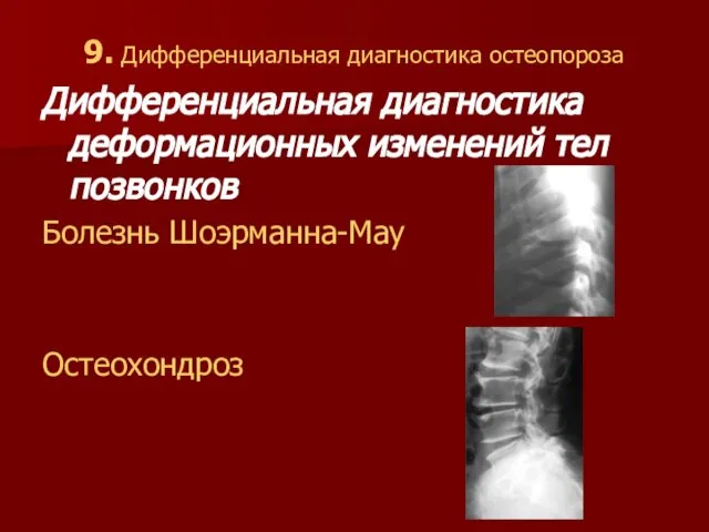 9. Дифференциальная диагностика остеопороза Дифференциальная диагностика деформационных изменений тел позвонков Болезнь Шоэрманна-Мау Остеохондроз