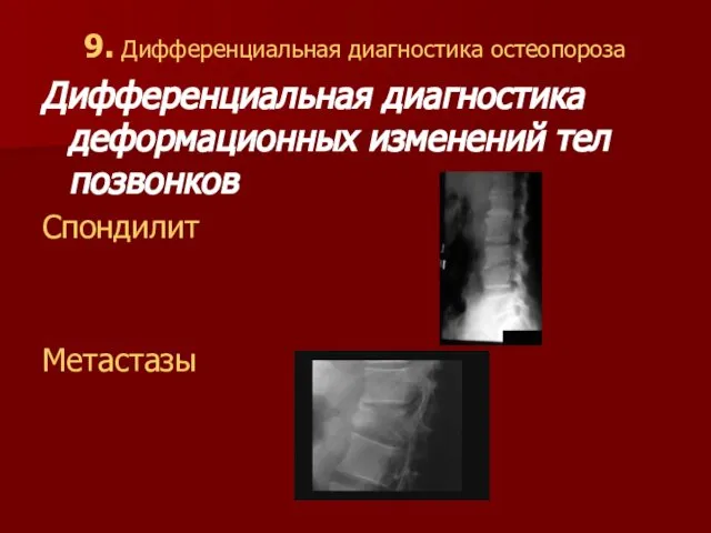 9. Дифференциальная диагностика остеопороза Дифференциальная диагностика деформационных изменений тел позвонков Спондилит Метастазы