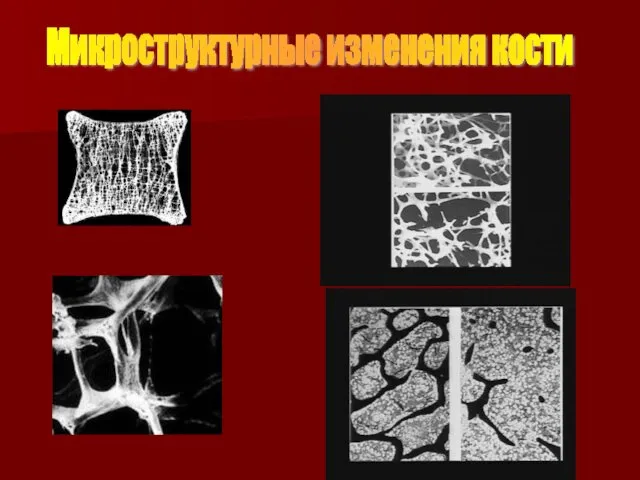 Микроструктурные изменения кости