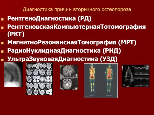 Диагностика причин вторичного остеопороза РентгеноДиагностика (РД) РентгеновскаяКомпьютернаяТотомография (РКТ) МагнитноРезонанснаяТомография (МРТ) РадиоНуклиднаяДиагностика (РНД) УльтраЗвуковаяДиагностика (УЗД)