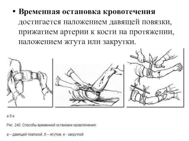 Временная остановка кровотечения достигается наложением давящей повязки, прижатием артерии к кости