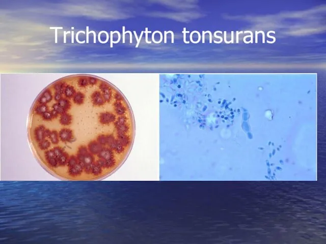 Trichophyton tonsurans