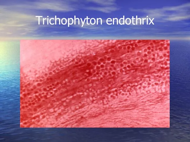 Trichophyton endothrix