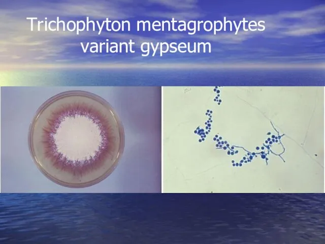 Trichophyton mentagrophytes variant gypseum