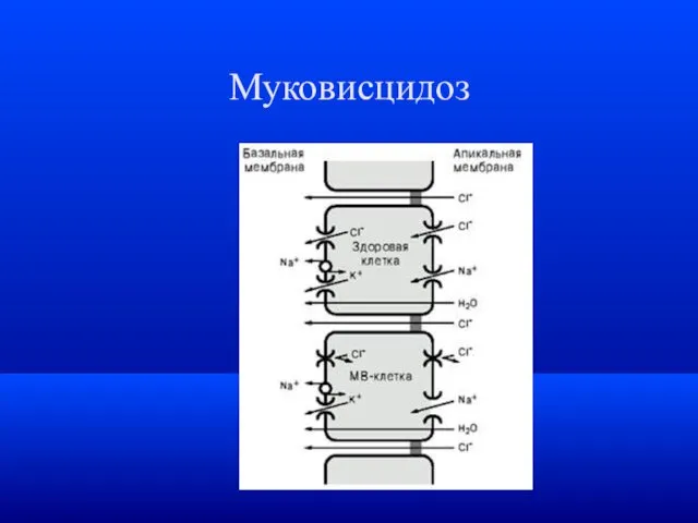 Муковисцидоз