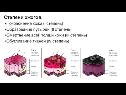 Степени ожогов: Покраснение кожи (I степень) Образование пузырей (II степень) Омертвение