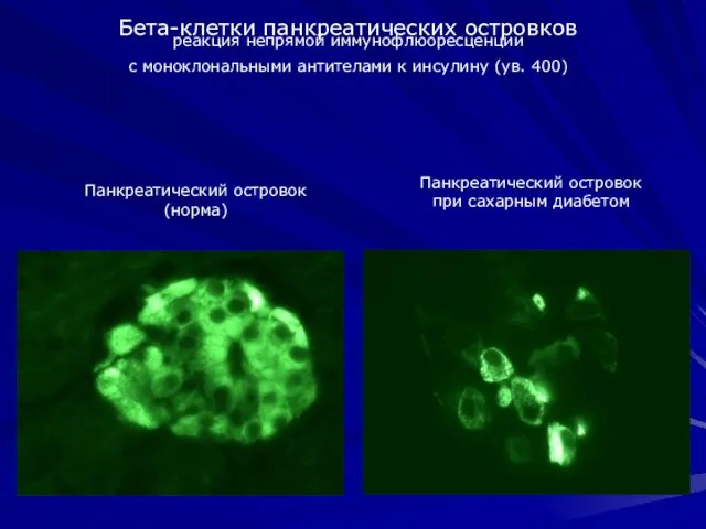 Панкреатический островок (норма) Панкреатический островок при сахарным диабетом Бета-клетки панкреатических островков