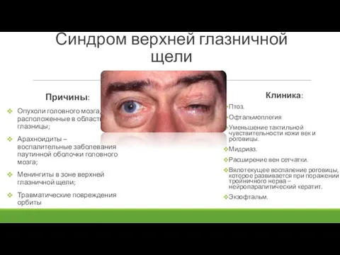 Синдром верхней глазничной щели Причины: Опухоли головного мозга, расположенные в области