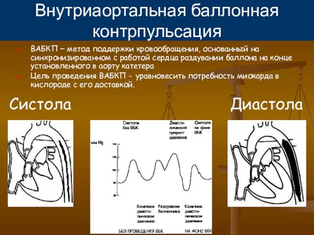 Внутриаортальная баллонная контрпульсация ВАБКП – метод поддержки кровообращения, основанный на синхронизированном