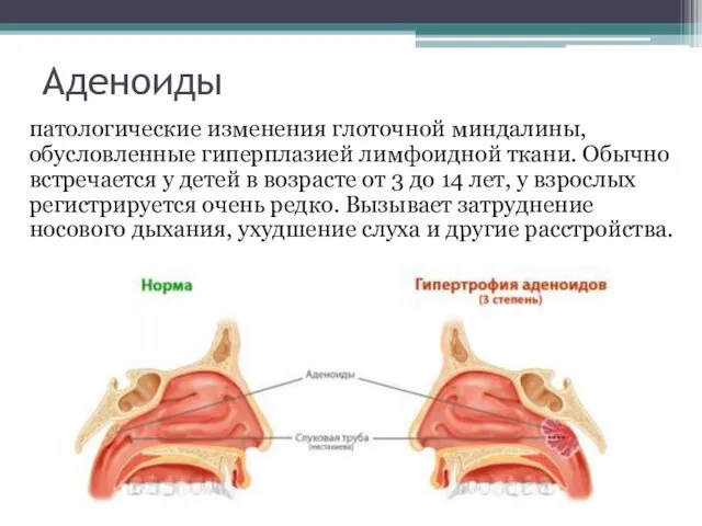 Аденоиды патологические изменения глоточной миндалины, обусловленные гиперплазией лимфоидной ткани. Обычно встречается