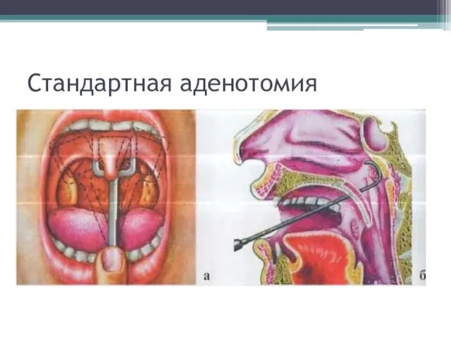 Стандартная аденотомия