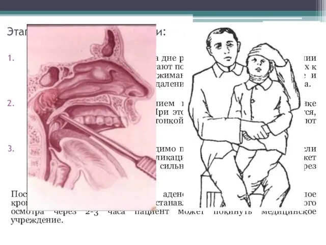 Этапы стандартной адетомии: Шпателем фиксируют язык на дне рта, аденотом по