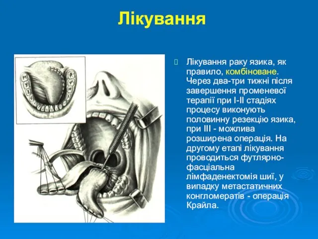 Лікування Лікування раку язика, як правило, комбіноване. Через два-три тижні після