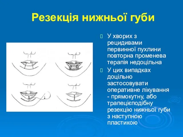 Резекція нижньої губи У хворих з рецидивами первинної пухлини повторна променева