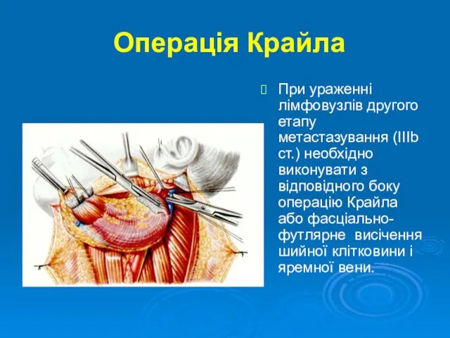 Операція Крайла При ураженні лімфовузлів другого етапу метастазування (IIIb ст.) необхідно