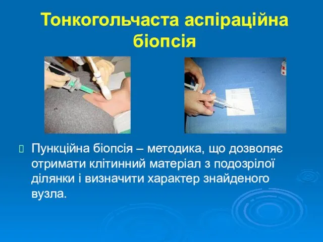 Тонкогольчаста аспіраційна біопсія Пункційна біопсія – методика, що дозволяє отримати клітинний