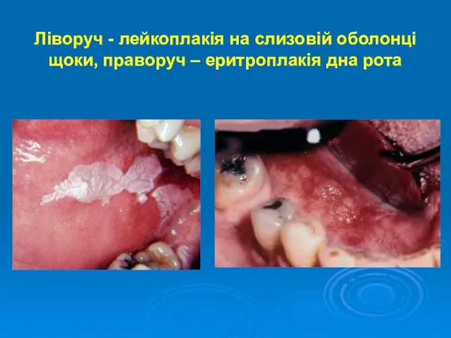 Ліворуч - лейкоплакія на слизовій оболонці щоки, праворуч – еритроплакія дна рота