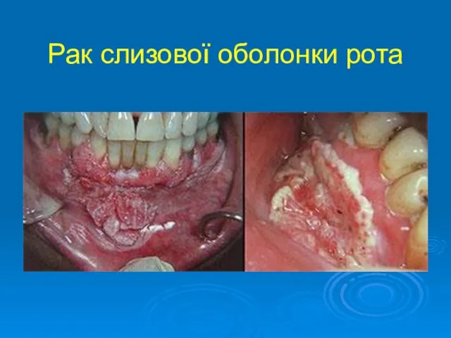 Рак слизової оболонки рота