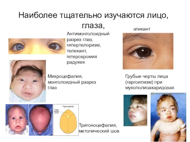 Наиболее тщательно изучаются лицо, глаза, Антимонголоидный разрез глаз, гипертелоризм, телекант, гетерохромия