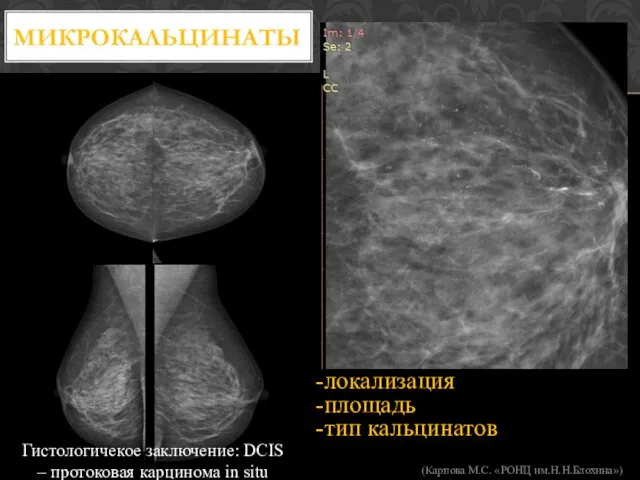 МИКРОКАЛЬЦИНАТЫ -локализация -площадь -тип кальцинатов (Карпова М.С. «РОНЦ им.Н.Н.Блохина») Гистологичекое заключение: