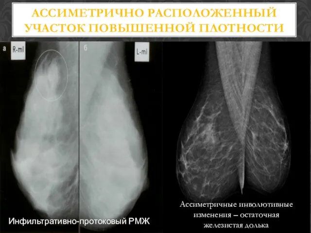 АССИМЕТРИЧНО РАСПОЛОЖЕННЫЙ УЧАСТОК ПОВЫШЕННОЙ ПЛОТНОСТИ Ассиметричные инволютивные изменения – остаточная железистая долька Инфильтративно-протоковый РМЖ